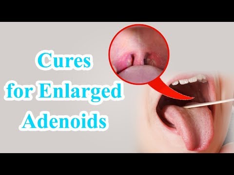 Video: Treatment Of Adenoids With Folk Remedies, At Home