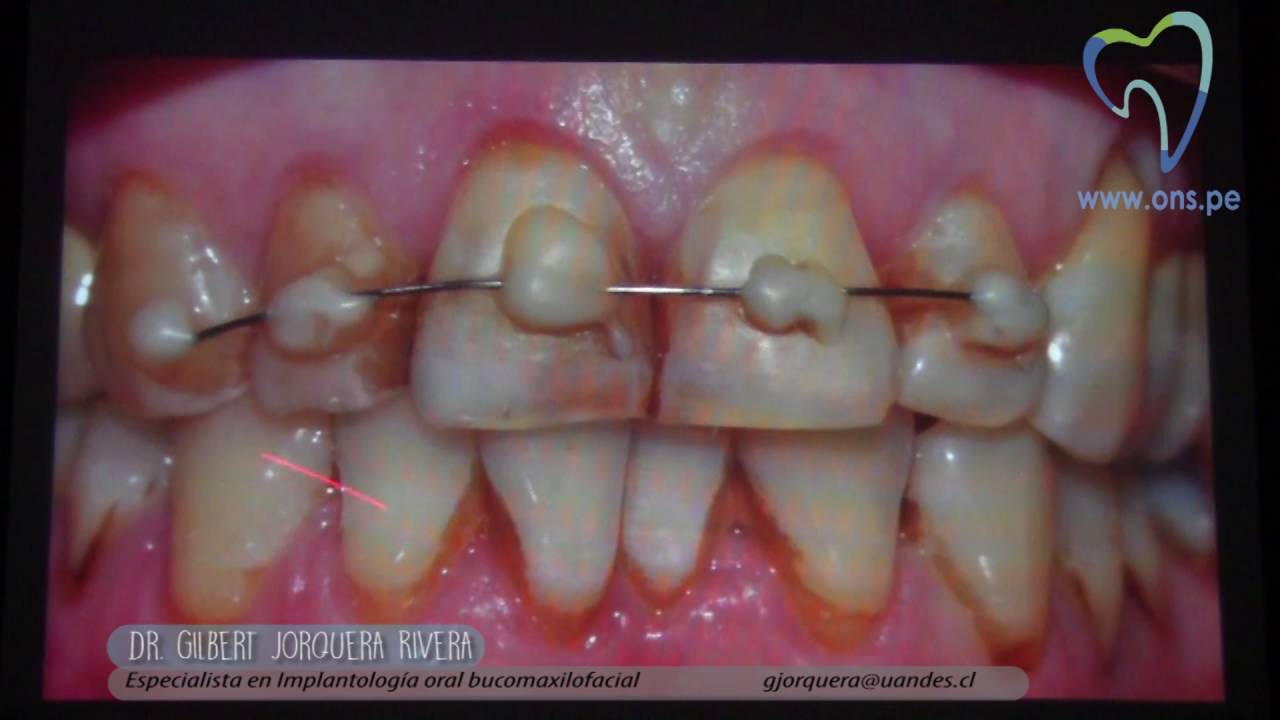 CAD CAM en prótesis sobre implantes negocios desde casa