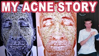 my ACNE story