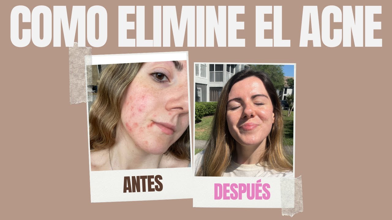 😱Como ELIMINÉ el ACNE después de 12 AÑOS: mi medico, productos y  tratamiento✅