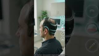 Norwood Stages Medical Surgical Restoration  #graftsurvival #hairrestorationscience #hairtransplant