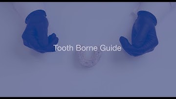 Tooth Borne Surgical Guide