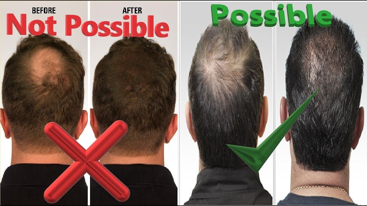 Prp Hair Loss Treatment Before And After Prp Hair Treatment Results