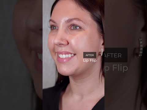 Lip Flip Before and After | Dr. Paul Nassif