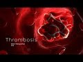 Thrombosis by pwarit