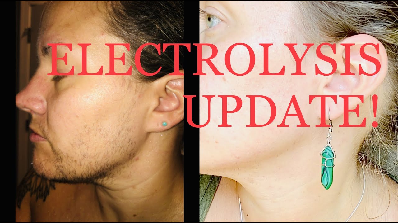 I m Back 135 Hrs Of Electrolysis Before After PCOS Hirsutism i-m-back-135-hrs-of-electrolysis-before-after-pcos-hirsutism