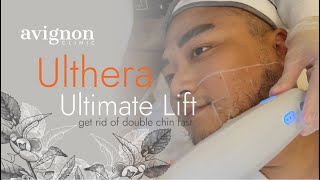 How can Avignon Ulthera Ultimate Lift reduce the appearance of Double Chin?