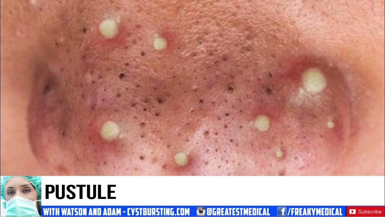 Blackheads And Blemishes Youtube