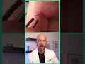 Doctor reacts to satisfying splinter removal! #dermreacts #doctorreacts #splinterremoval