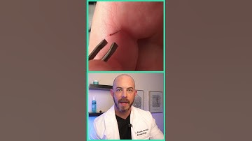 Doctor reacts to satisfying splinter removal! #dermreacts #doctorreacts #splinterremoval