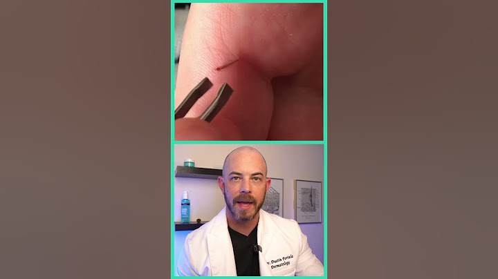 Doctor reacts to satisfying splinter removal! #dermreacts #doctorreacts #splinterremoval