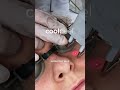 COOLPEEL: Rejuvenecimiento facial sin baja médica. El tratamiento CoolPeel® se caracteriza por sesi