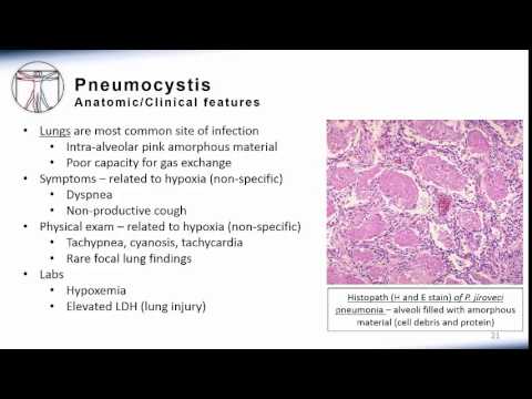 5. Pneumonia Pneumocystis