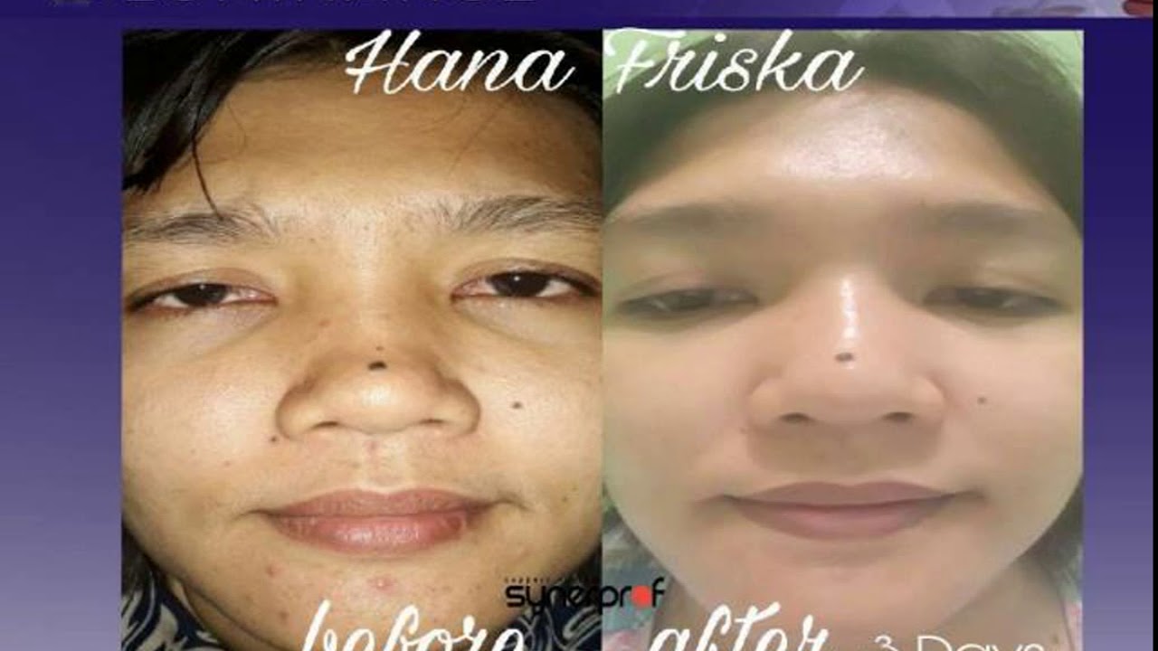 WA atau SMS 0852 1118 2605 cara menghilangkan flek hitam di wajah bekas