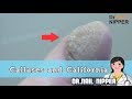 Two Patient Callus and California #31 - Dr Nail Nipper's Callus Tuesday