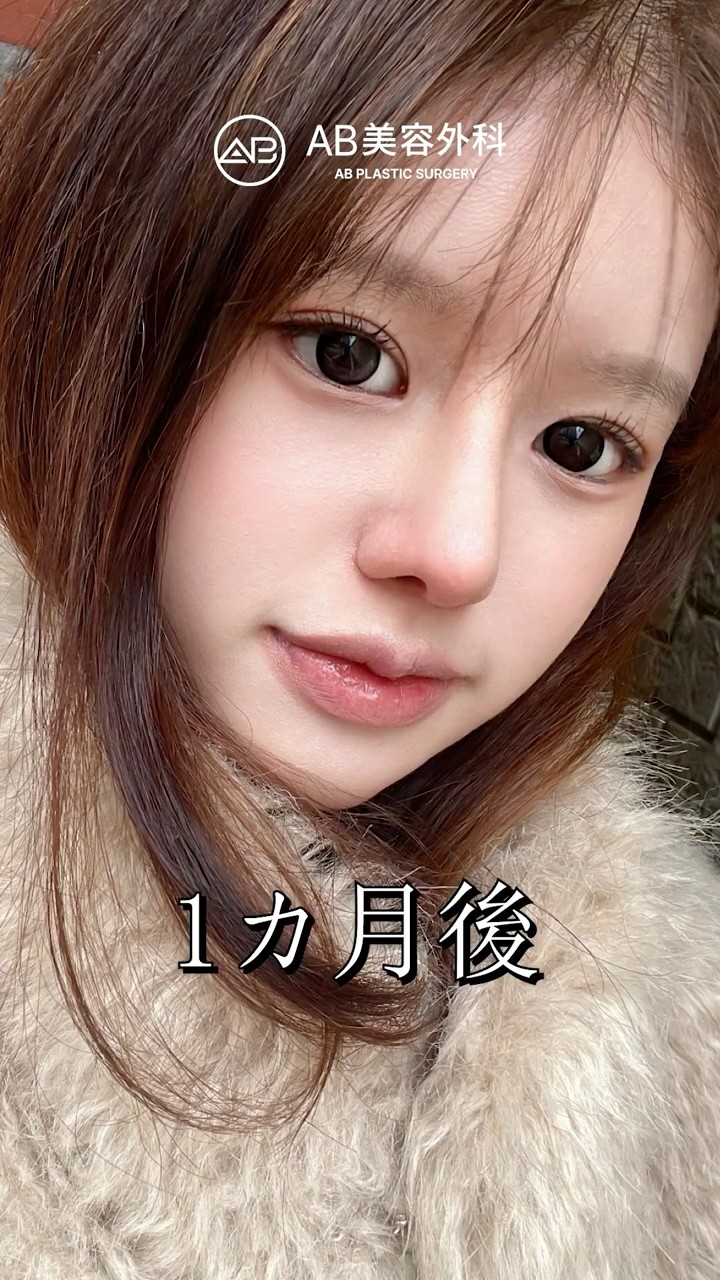 目整形・鼻整形で自信を手に入れた女性 #Shorts