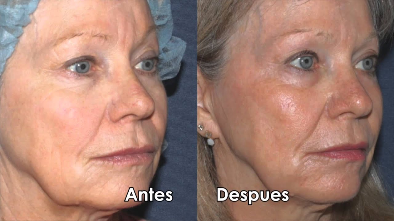 Banner for Botox para las arrugas faciales | Dr. Sabrina Fabi