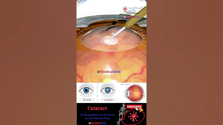 Cataract - Lens Implant - Medical Arts Shorts - 3d animation surgery - DayDayNews