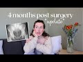 4-Month Post-Surgery Update ☀️: Acetabuloplasty &amp; Hip Osteotomy Recovery Journey | Hip Arthroscopy