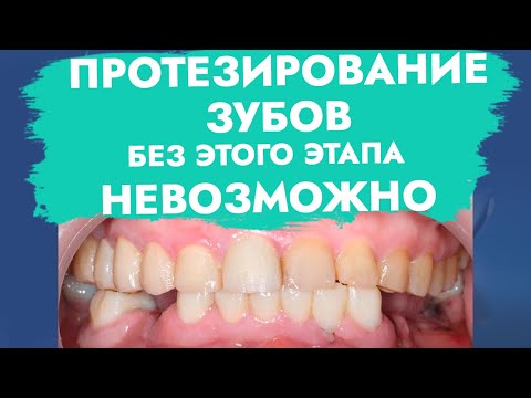 Протезирование зубов без этого этапа невозможно.