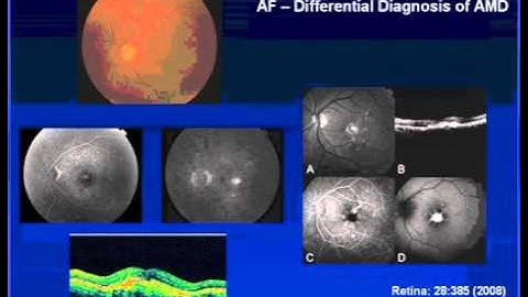 Utilizing Autofluorescence in AMD