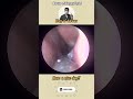 @귀지형 #콧물 #부비동염 #축농증 #비염 #코청소 #이비인후과 #rhinorrhea #rhinitis #sinusitis #asmr