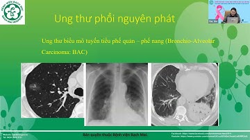 CẬP NHẬT CHẨN ĐOÁN, ĐIỀU TRỊ UNG THƯ PHỔI VÀ UNG THƯ VÚ BUỔI 2
