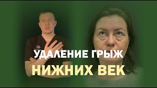 Круговая блефаропластика: смотри результат через 3 недели!