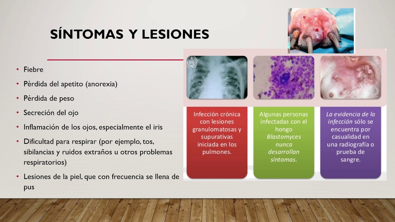 Blastomicosis YouTube