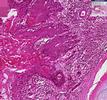 Histopathology Lung -- Squamous cell carcinoma