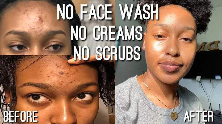 I QUIT USING ACNE PRODUCTS TO CLEAR MY SKIN (W/Photos)