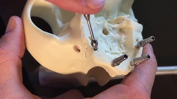 Non-engaging  multi unit abutments Neodent (mini conical)