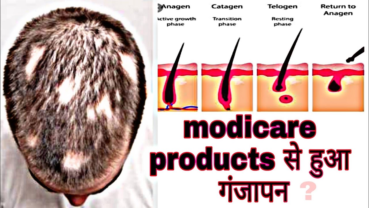 modicare product for stretch marks