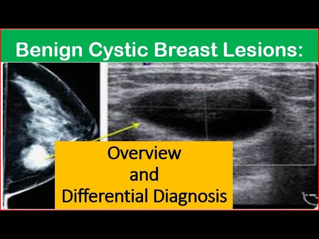 Breast Cyst Ultrasound Radiology