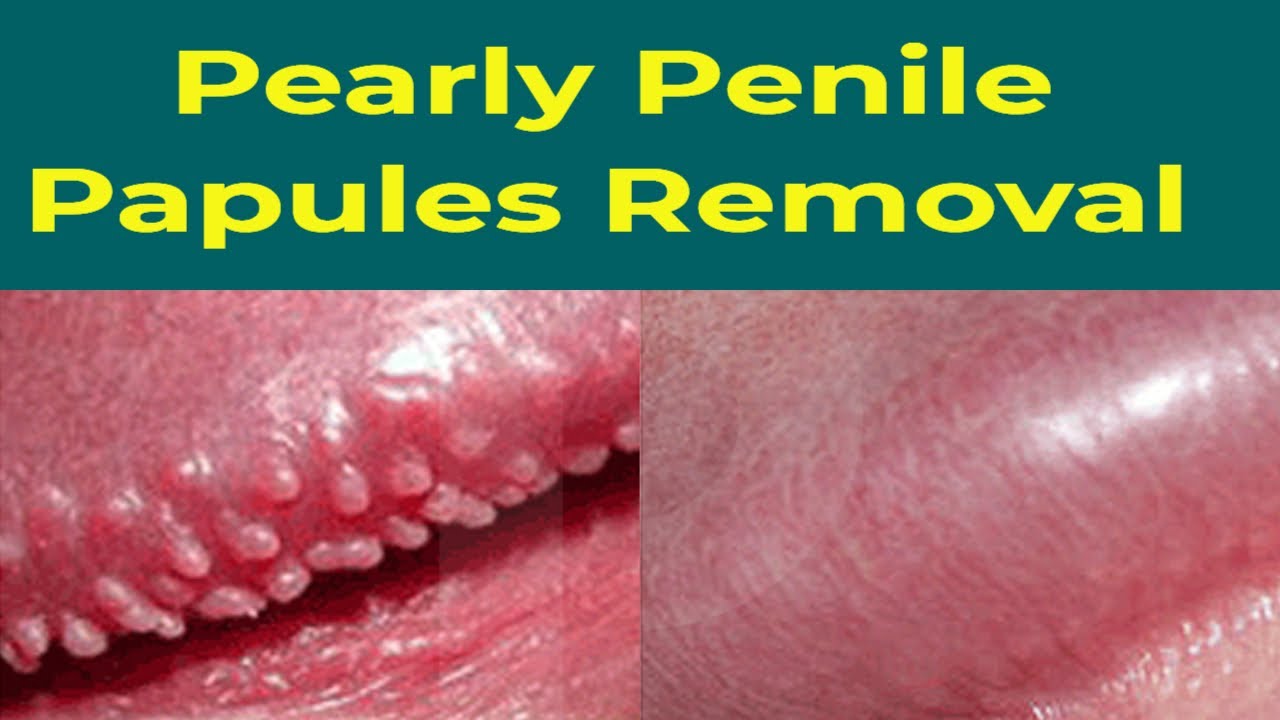 Pearly Penile Papules Removal, Does It Work? - YouTube