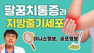 테니스엘보, 골프엘보 등의 팔꿈치 통증 치료에 효과적인 줄기세포