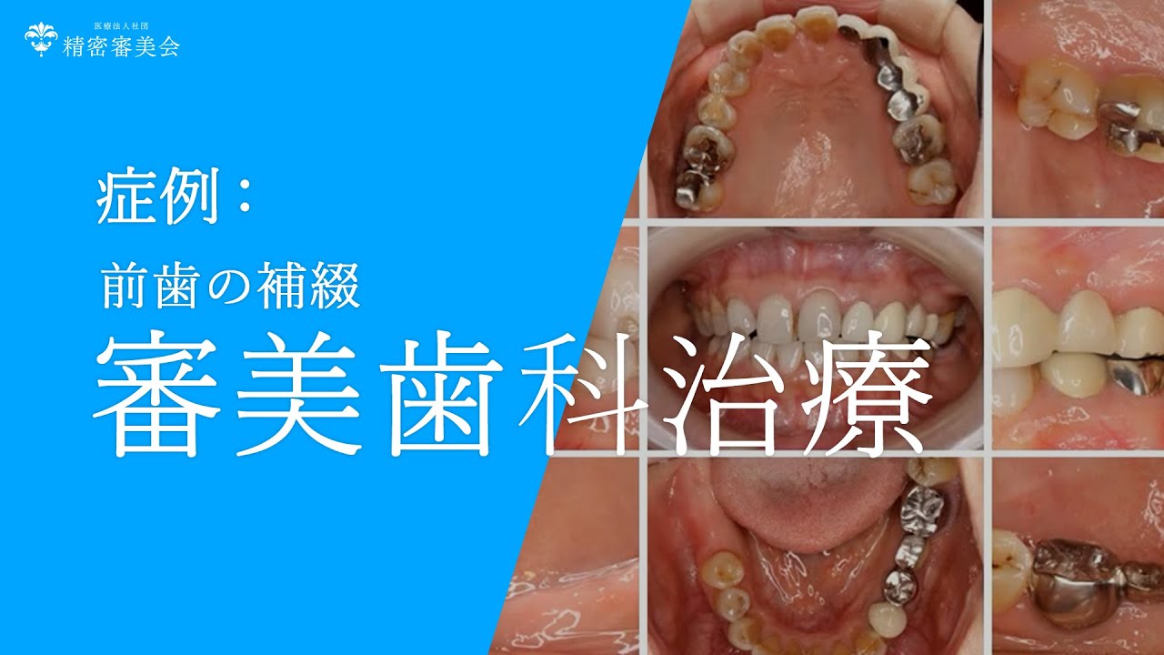 色素沈着したラミネートベニヤをクラウンへやり換える前歯の審美補綴
