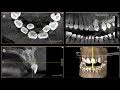 Impacted Supernumerary (Extra Tooth) Removal