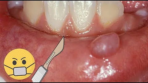 Como identificar mucocele?