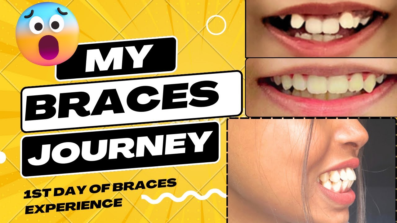 MY BRACES JOURNEY| ITNA LATE BRACES LGA MERA 🥹🙀 | WHY ?🙀 #metalbraces #braces treatment #dentist