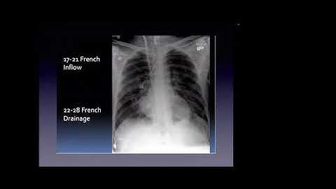 STEP N-Nursing Care of ECMO Patient-Dr Chandrashish Chakraborty