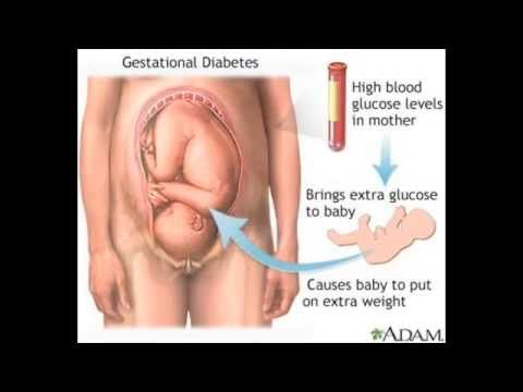 gestational-diabetes-symptoms