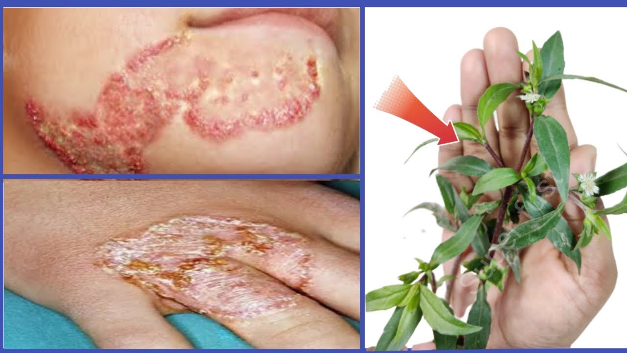 How to 2 Days Fungal infection Treatment at Home 