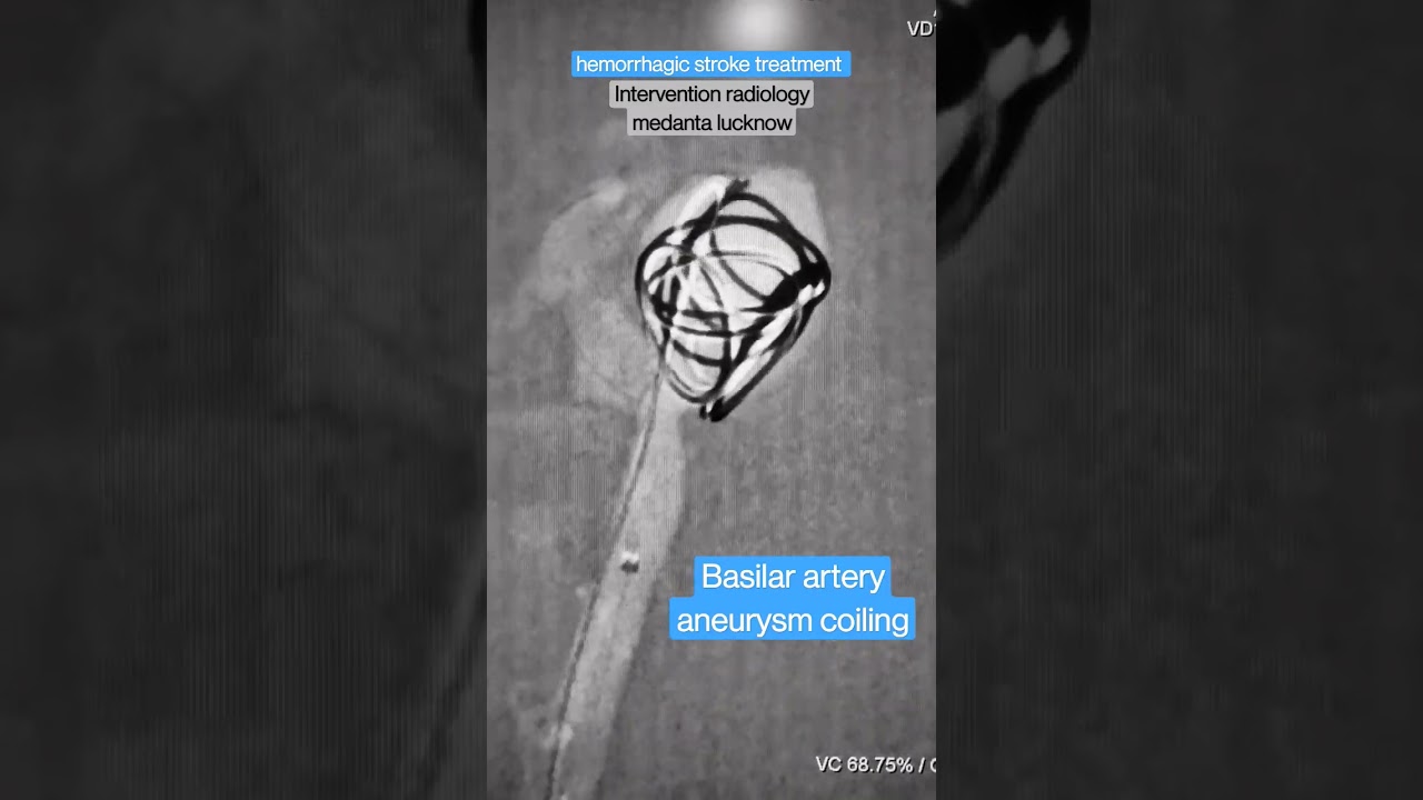 Brain aneurysm coiling