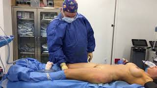 Umbilicoplasty, Liposuction Of Inner Thighs And Inner Knees Umbilicoplasty, Liposuction Of Inner Thighs And Inner Knees