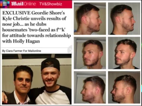 Geordie Shore's Kyle Christie talks about his Nose Job by Mr Sultan Hassan of Elite Surgical