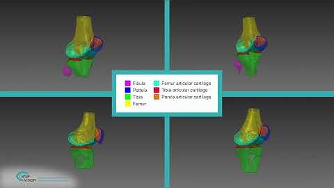 Automated Cartilage Segmentation for Sports Medicine Applications  5