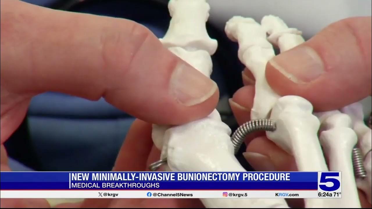 medical-breakthrough-new-minimally-invasive-bunionectomy-procedure