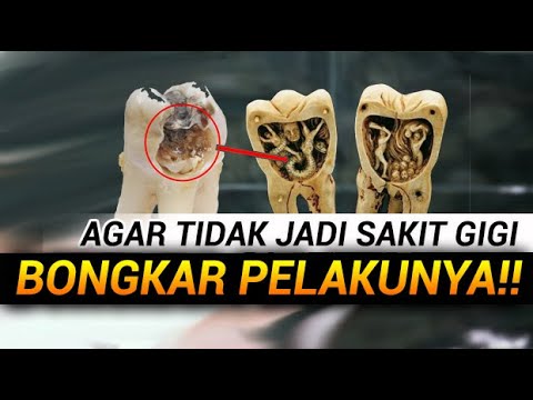 Telah DITEMUKAN Penyebab Sakit Gigi Selama Ini