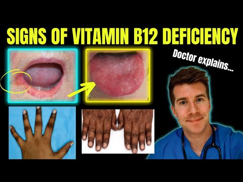 Video: Ar gerklė gali sukelti vitaminų trūkumą?